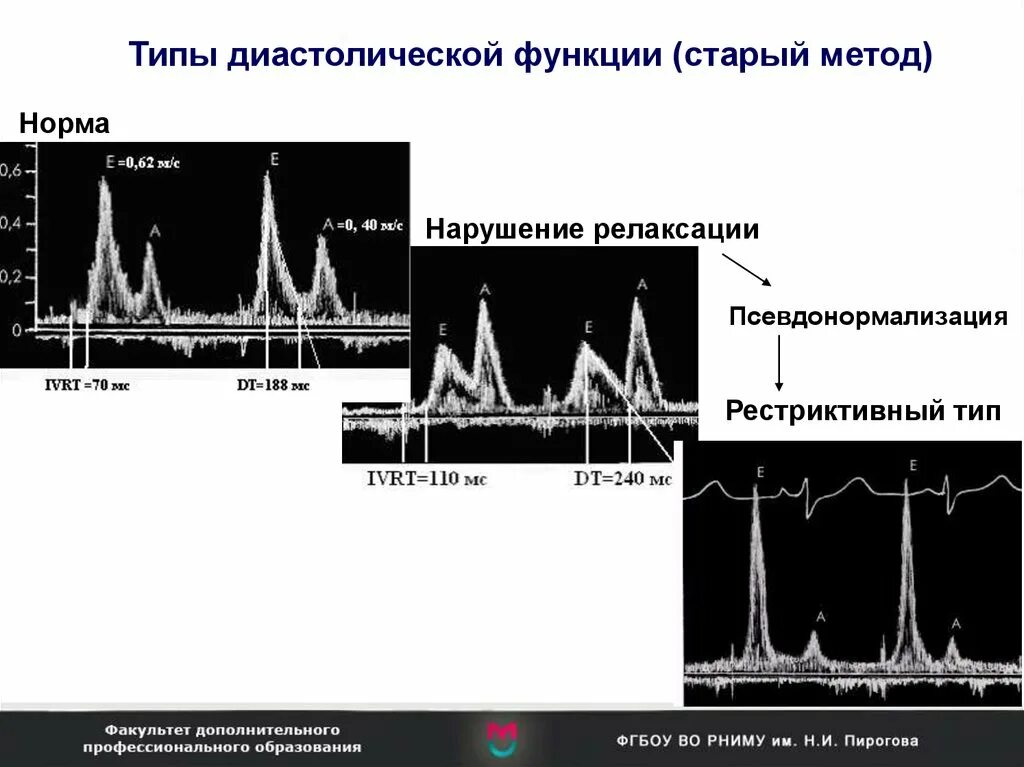 Оценка диастолической функции лж по ЭХОКГ. Диастолическая дисфункция на ЭХОКГ. Диастолическая дисфункция левого желудочка на ЭХОКГ. Диастолическая дисфункция левого желудочка тканевой допплер.