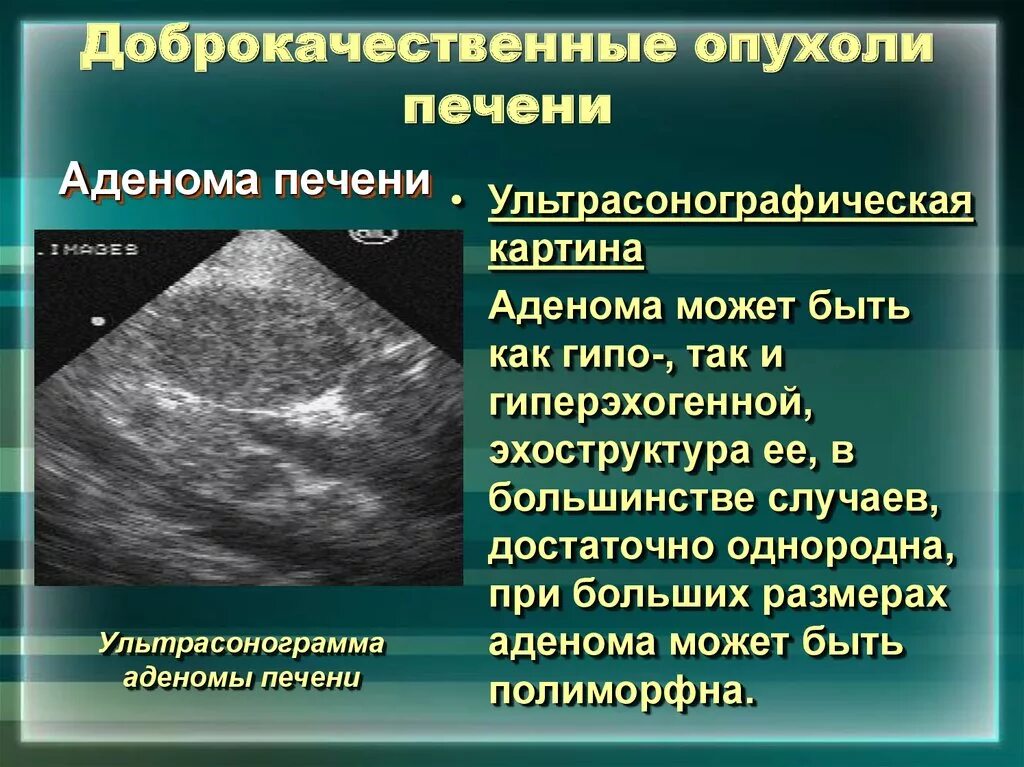 Образование в правой доле печени. Гепатоцеллюлярная аденома УЗИ. Новообразование в печени на УЗИ. Объемные образования печени на УЗИ. Доброкачественные опухоли печени на УЗИ.