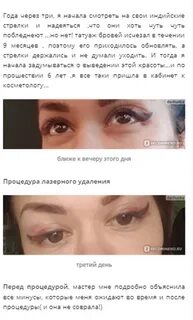 Чем лучше удалять брови лазером или ремувером