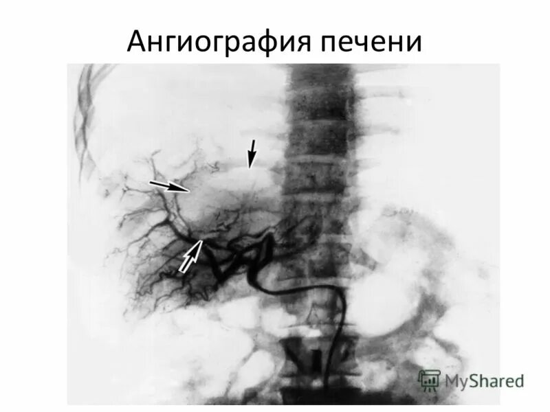 Башня рован ангиография. Воротная вена ангиография. Компьютерно-томографическая ангиография печени. Ангиография чревного ствола. Ангиография верхней брыжеечной артерии.