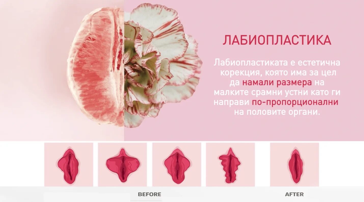 Маленькие малые губы. Малые половые губы лабиопластика. пластика лабиопластика. редукционная лабиопластика. лабо поастика.