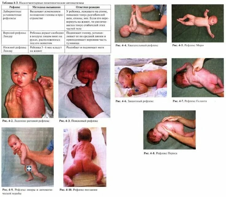 Рефлекс Галанта у новорожденных. Рефлекс Ландау у новорожденных. Рефлекс Ландау у грудничка. Верхний рефлекс Ландау.