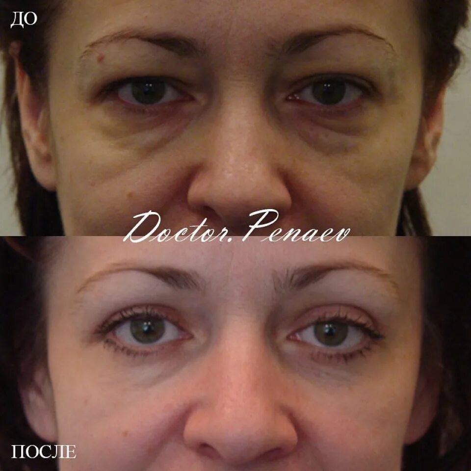 аквалифтинг лица что это такое. пациентка 46 лет. подглазничная гипоплазия лица. только в г,адлер пластика контур лица и шеи без операции. пациентка 46 лет.