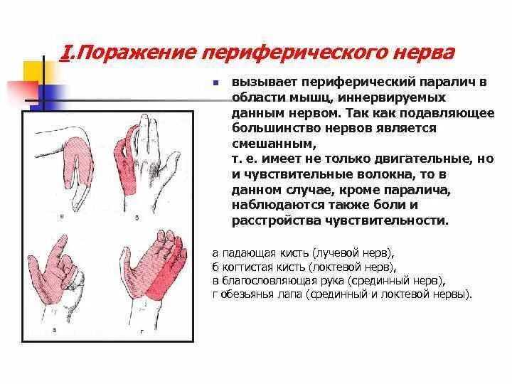 Поражение двигательного нерва