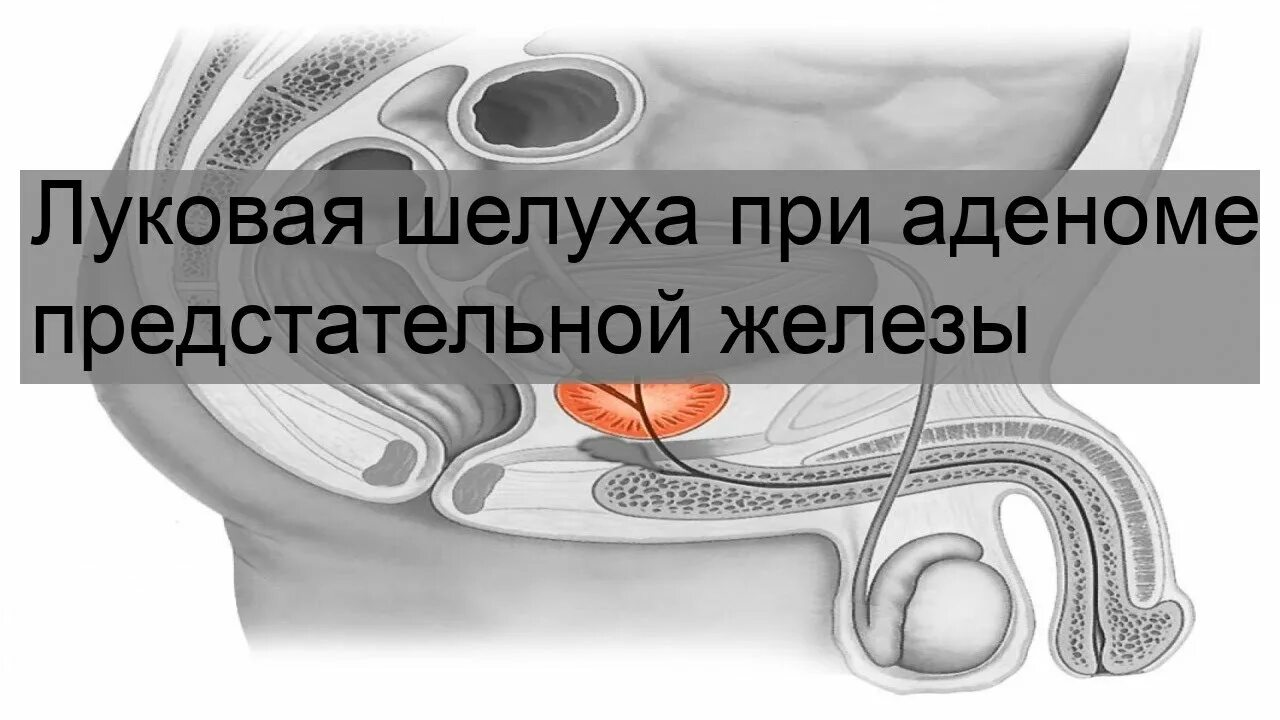 Шелуха от простатита. Препараты при аденоме предстательной железы. Аденома предстательной железы лечение. Рецидив аденомы простаты. Свечи при аденоме простаты.