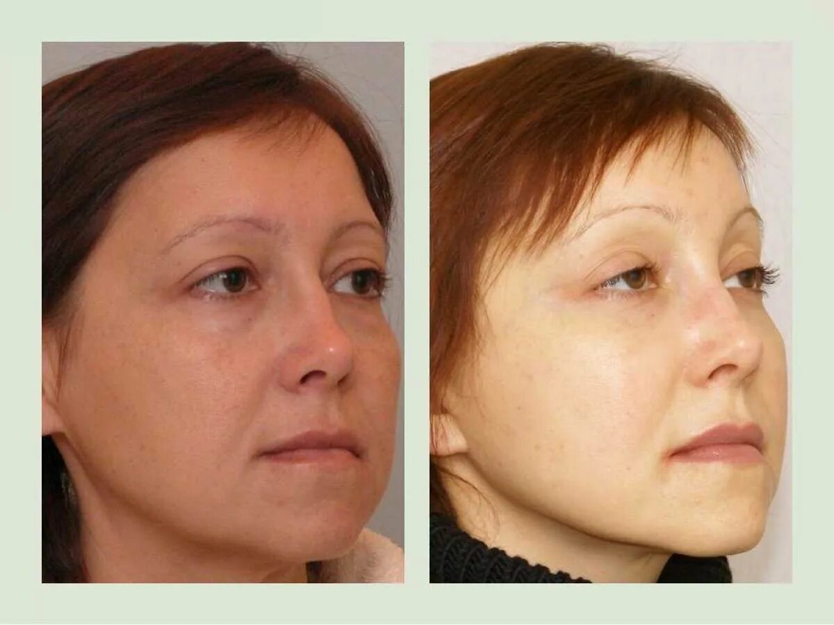 височный лифтинг. фейслифтинг височный лифтинг. темпоропластика височный лифтинг. эндоскопический лобно-височный лифтинг. височный лифтинг что это такое.