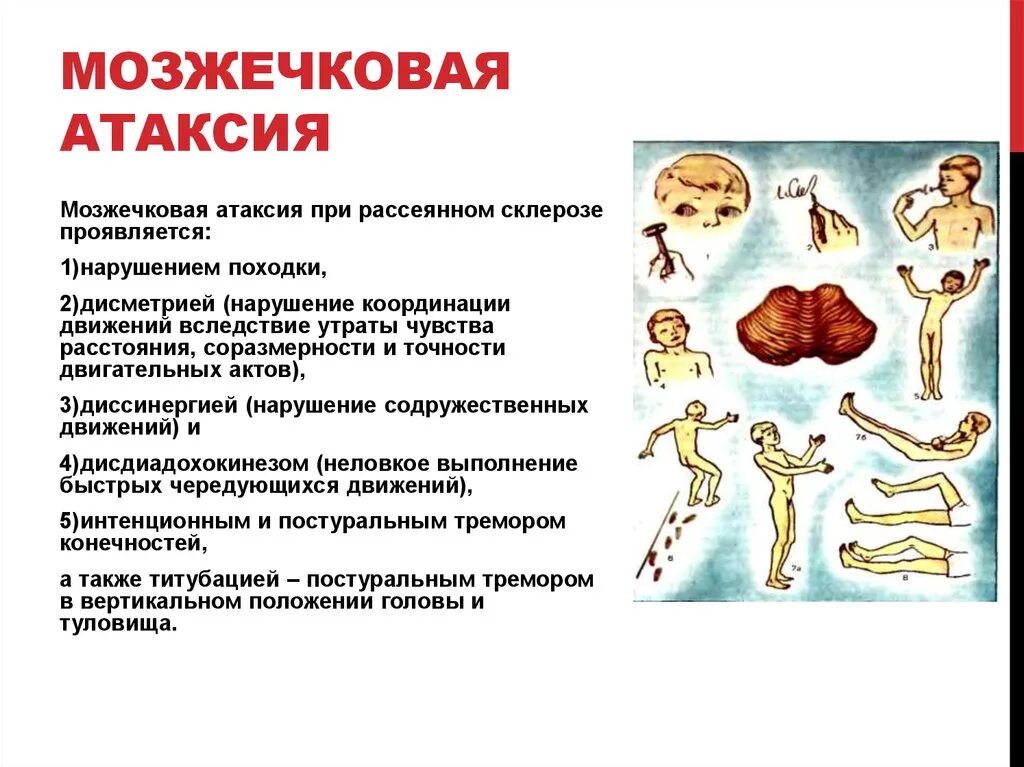 Демиелинизация спинного мозга мрт. Патоморфология рассеянного склероза. Рассеянный склероз на мрт головного мозга. Демиелинизация спинного мозга мрт. Очаги в головном мозге на мрт рассеянный склероз.