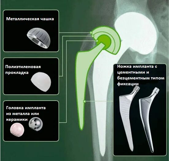 Цементная мантия эндопротеза тазобедренного сустава. Бесцементный эндопротез тазобедренного сустава. Загородний эндопротезирование тазобедренного сустава. Цементная фиксация эндопротеза тазобедренного сустава.