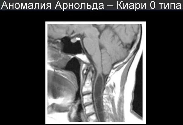 Аномалия арнольда. Арнольда киари аномалия у плода. аномалия арнольда киари 2 типа. аномалия киари 1 типа на мрт.