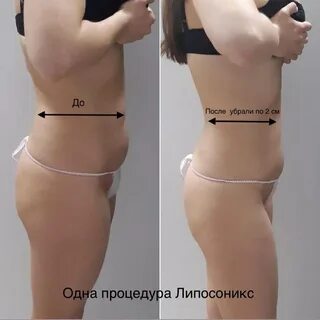 Похудение липосоникс отзывы