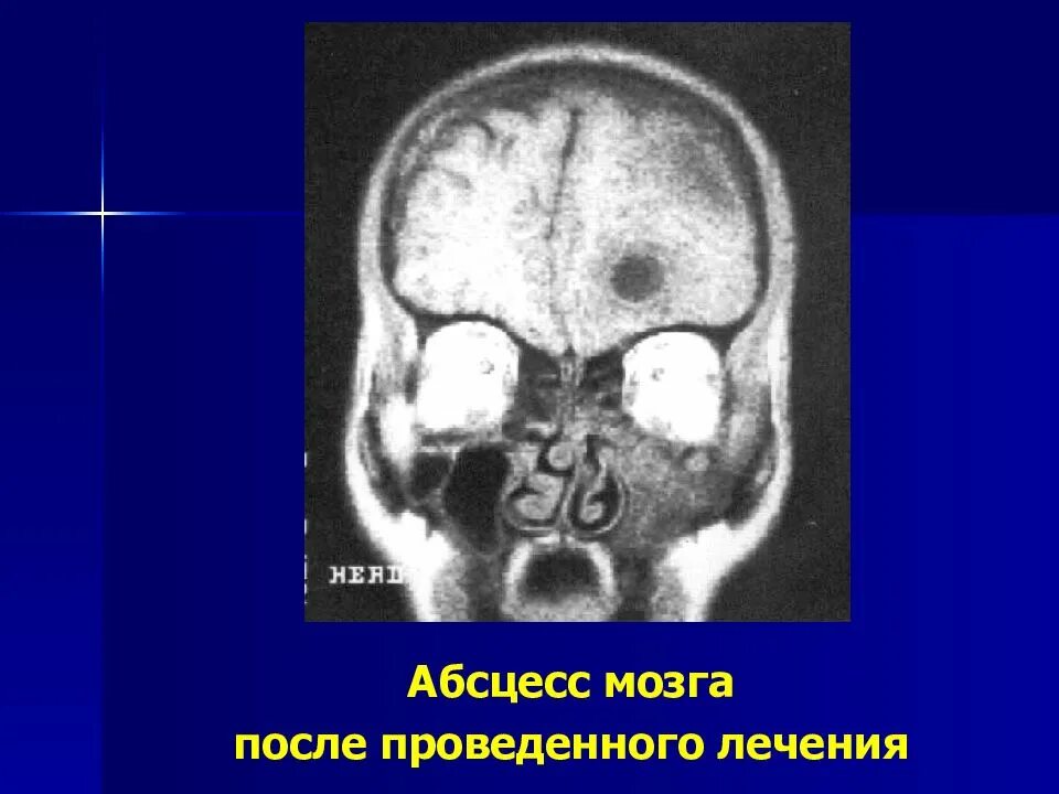 Абсцесс мозга. Орбитальные и внутричерепные осложнения. Внутричерепной абсцесс. Абсцесс мозга осложнения. Внутричерепные осложнения синусита.