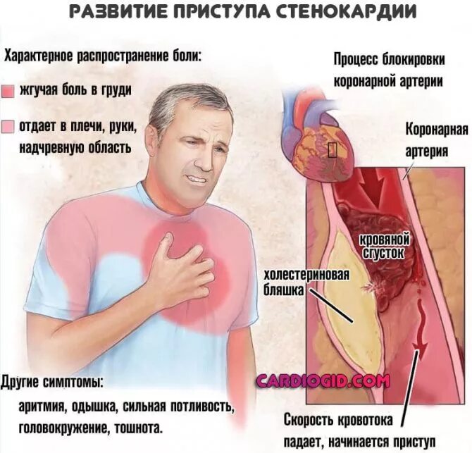 Щемящая боль. Острая коронарная недостаточность симптомы. Синдром острой коронарной недостаточности симптомы. Приступ стенокардии.