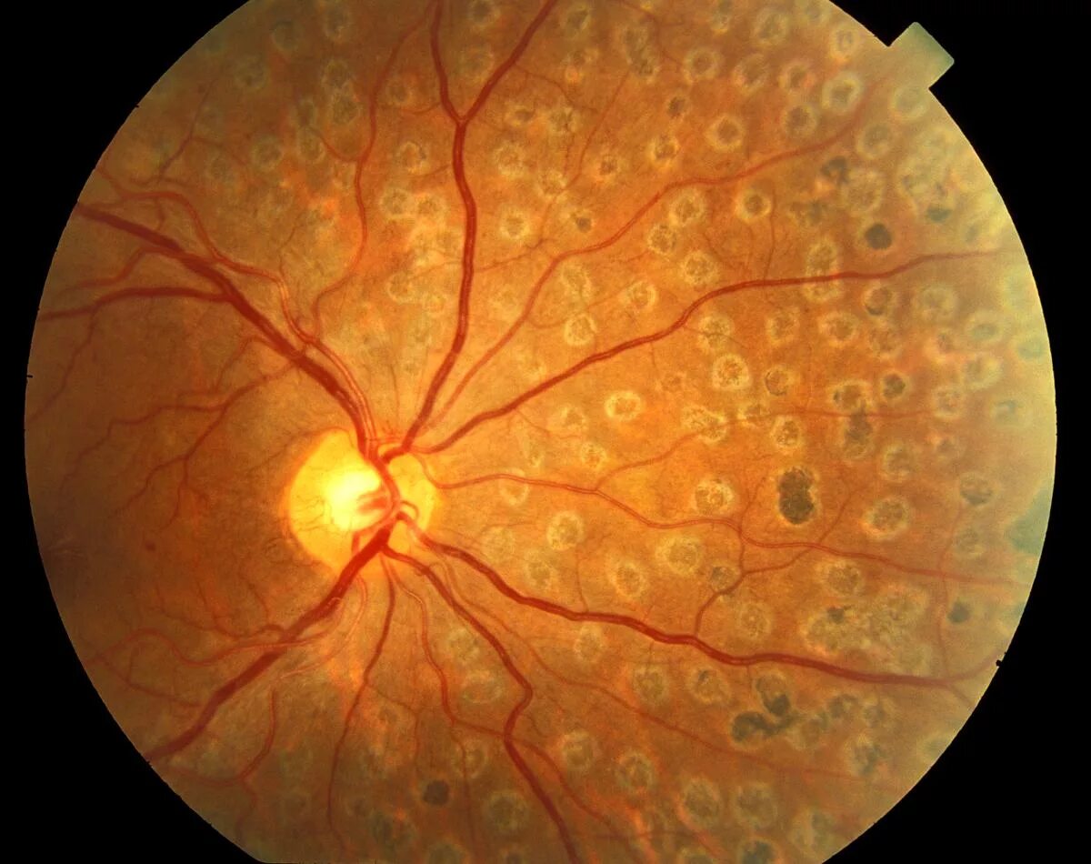 Посттромботическая ретинопатия. Макула дистрофия сетчатки. Макулярная ретинопатия.
