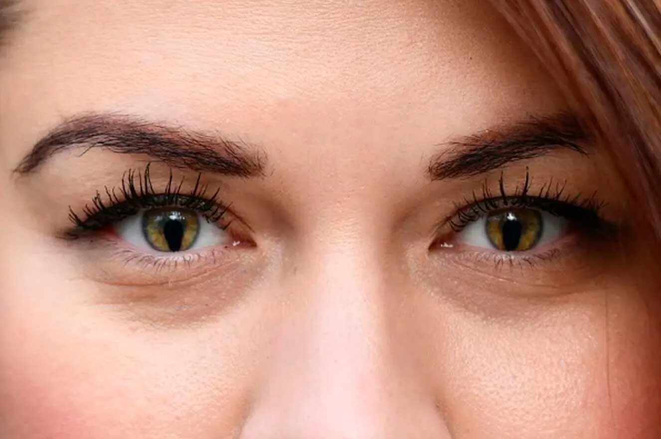 Колобом глаза. Колобом глаза. Колобом глаза. Колобома радужной сетчатки. Колобом глаза.