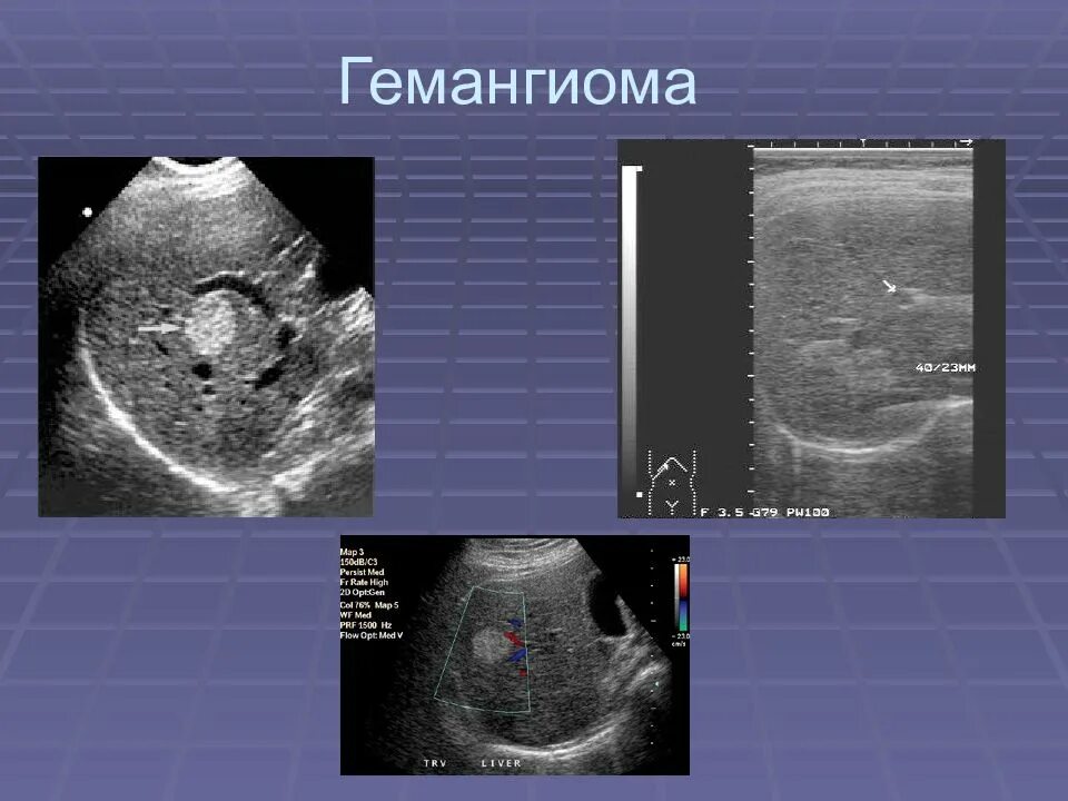 Очаговые гемангиомы печени. Гистогенез гемангиомы печени. Кавернозная гемангиома селезенки УЗИ.