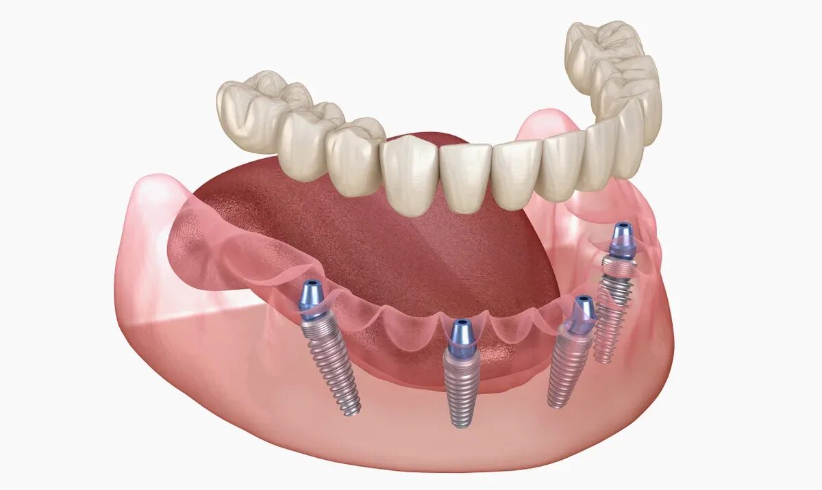 Несъемный протез на 4 имплантах. Внутрислизистые зубные имплантаты.