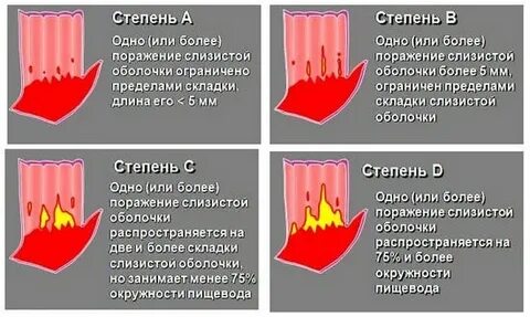 Гэрб эрозивный эзофагит