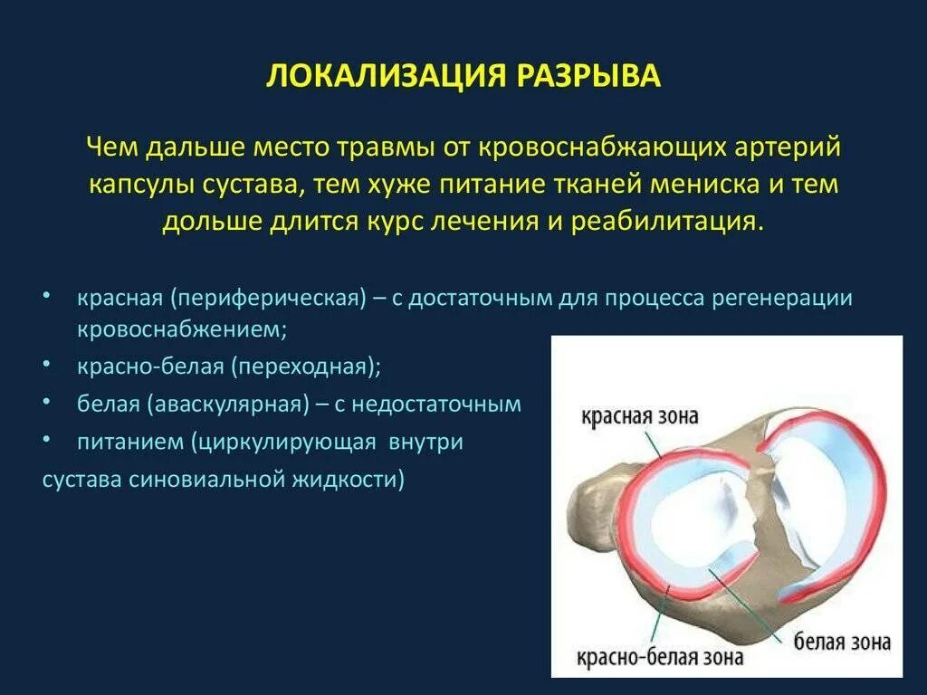 Дегенеративные изменения переднего рога. Рог мениска повреждение мениска коленного сустава. Разрыв мениска коленного сустава рентген. Разрыв рога мениска коленного сустава. Коленный сустав строение мениск.