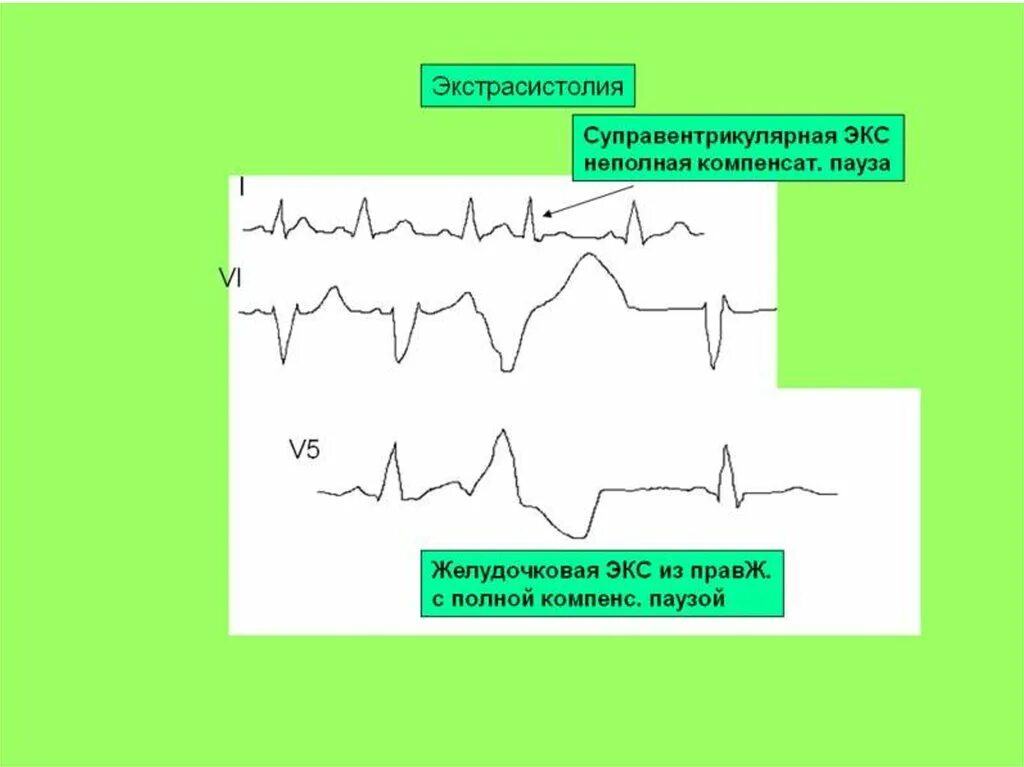 Желудочковая экстрасистолия заключение ЭКГ. Ритм при желудочковой экстрасистолии на ЭКГ. Желудочковая экстрасистолия с блокадой. Av блокады и экстрасистолы на ЭКГ. Экстрасистолы у женщин