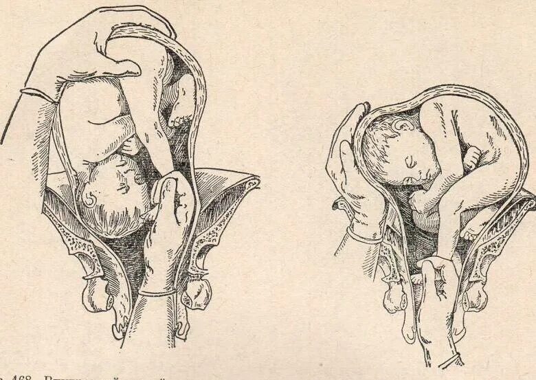 Акушерский переворот при тазовом предлежании. Наружный акушерский поворот плода. Амбруаз паре поворот плода на ножку. Тазовое ножное предлежание плода. Спала перед родами