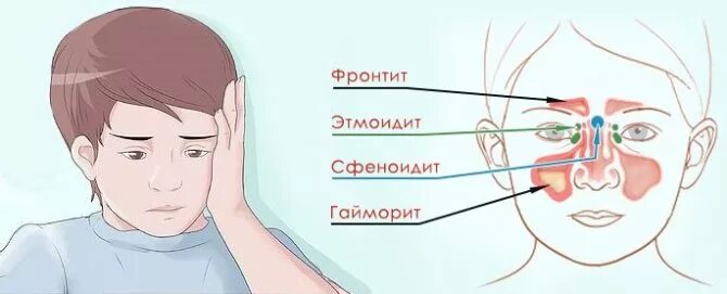 Риносинусит у ребенка симптомы. Гайморит фронтит этмоидит сфеноидит. симптомы риносинусита у детей.