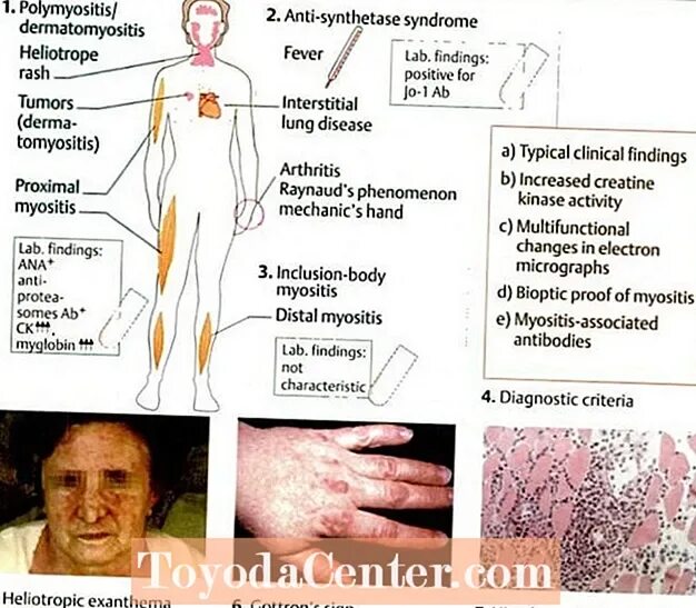 Полимиозит что это. Рука механика при дерматомиозите. Особые симптомы при дерматомиозите и полимиозите.