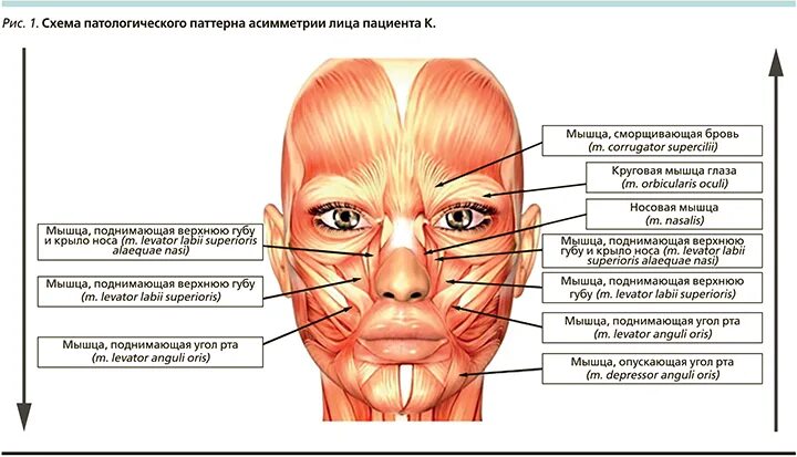 Крепление мышцы поднимающей верхнюю губу. Levator anguli oris. Мышца поднимающая крыло носа. Мышца поднимающая верхнюю губу и крыло носа. Мышца поднимающая верхнюю губу иннервация.
