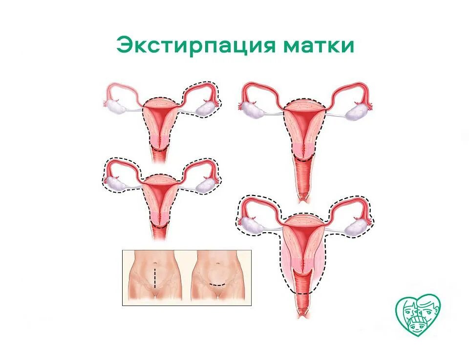 Гистерэктомия с придатками. Ампутация и экстирпация матки. тотальная гистерэктомия. вагинальная гистерэктомия.