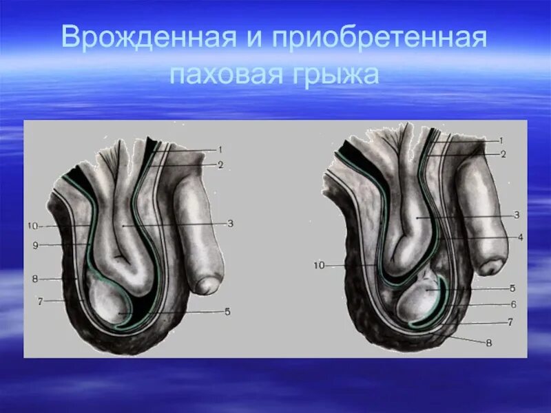 Цена лечения паховых грыж. Пахово-мошоночная грыжа. Врожденная и приобретенная косая паховая грыжа. Косая приобретенная паховая грыжа. Врожденная косая паховая грыжа схема.