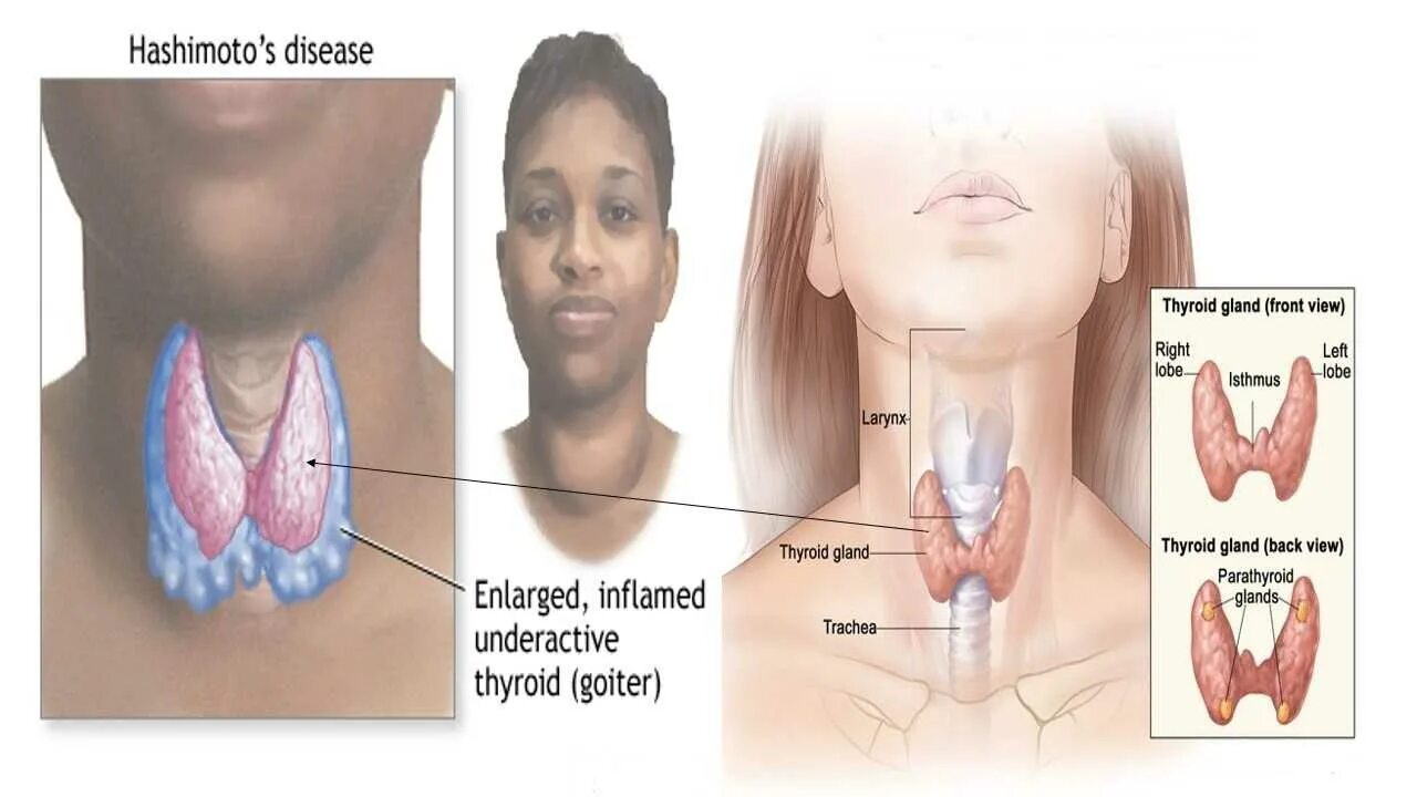 Тиреоидит Хашимото атрофического. Тиреоидит Хашимото зоб. Тиреоидит Хашимото щитовидной железы что это такое. Лимфоматозный тиреоидит. Аутоиммунный зоб