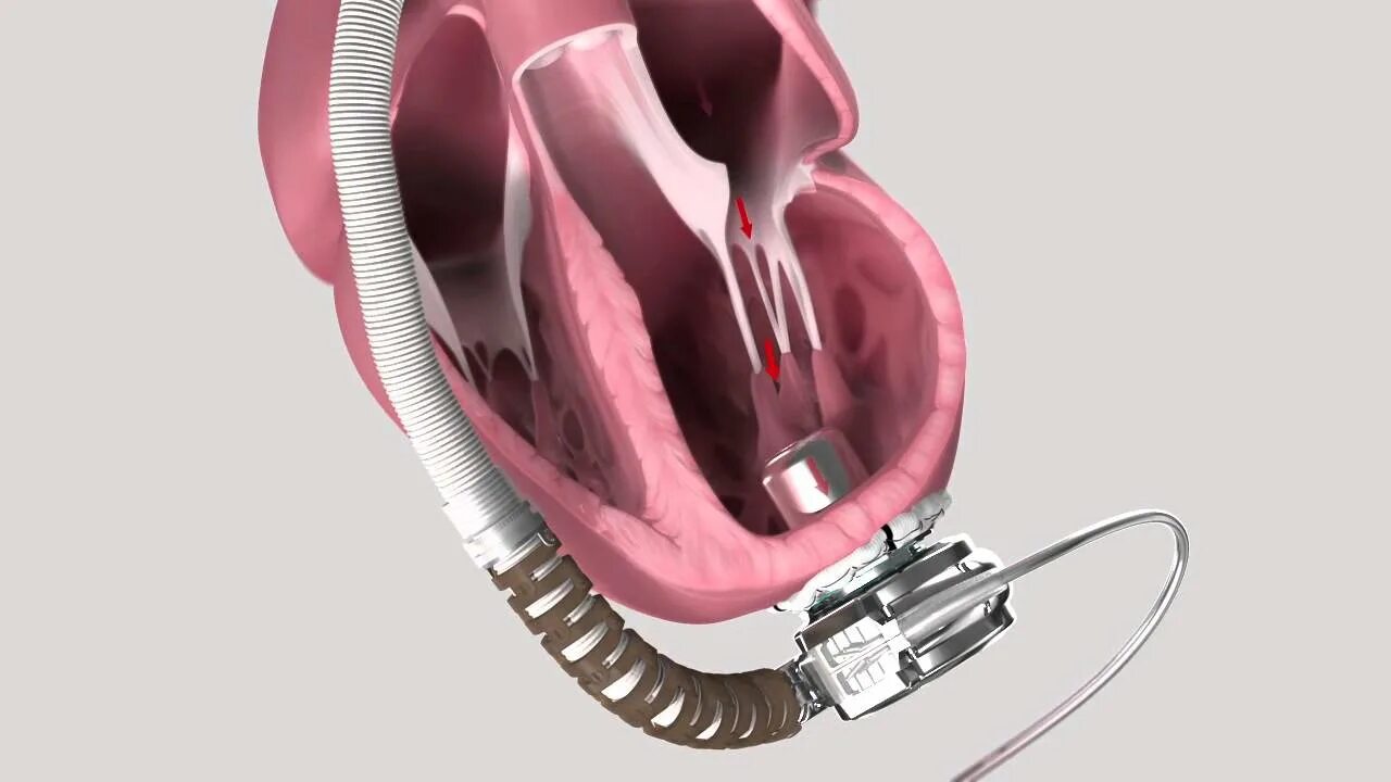 Искусственного левого желудочка (LVAD).