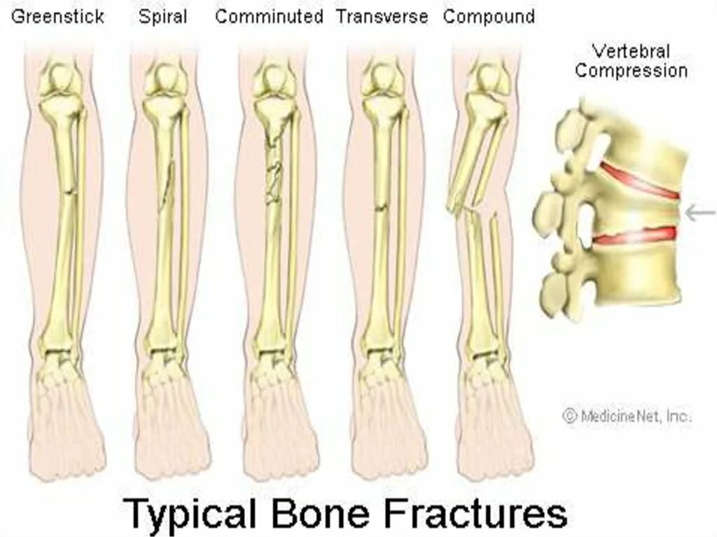 Перелом кости может быть каким. Типы переломов костей конечностей.