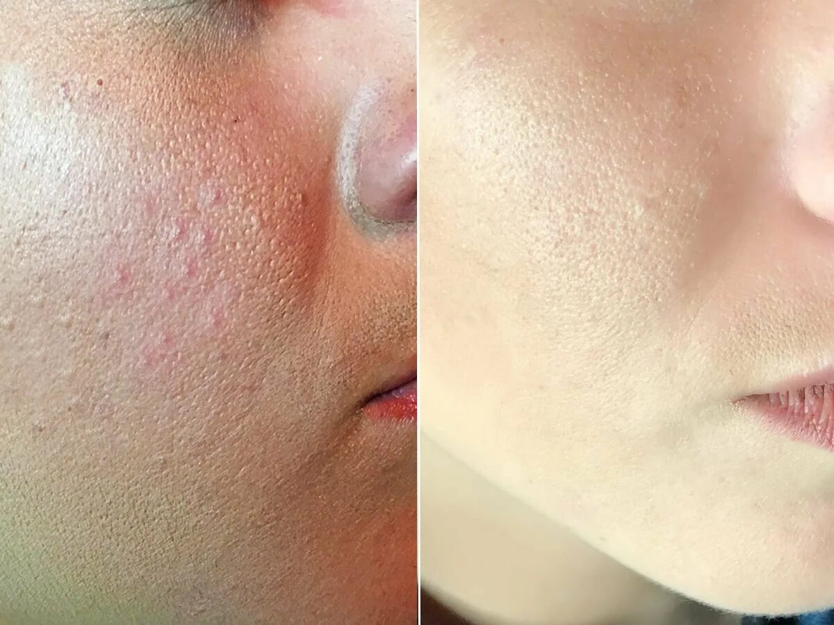 Анализы при прыщах на лице. Прыщи на лбу у женщин какой орган не в порядке. Прыщи на лице какой гормон. Внутренние причины акне. Заболевания органов по прыщам на лице.