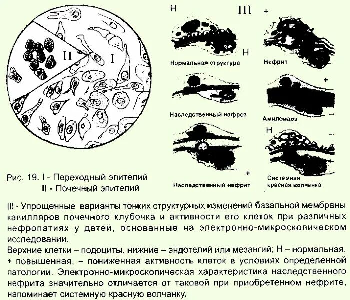 Повышенный эпителий в моче у мужчин