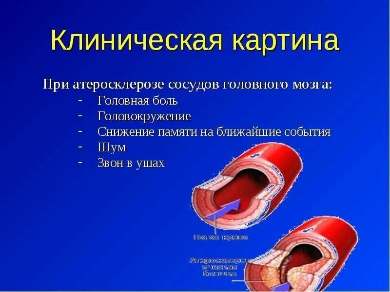 Головного мозга атеросклероз народное средство. Клиническая картина атеросклероза. Атеросклероз сосудов головного мозга.