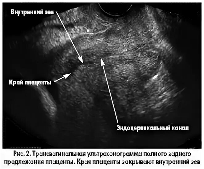 Расположение плаценты на УЗИ. Предлежание плаценты на УЗИ. Зев закрыт при беременности