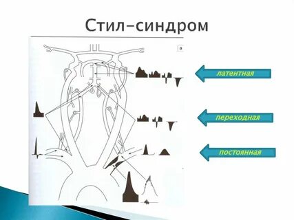 Обкрадывания подключичной артерии
