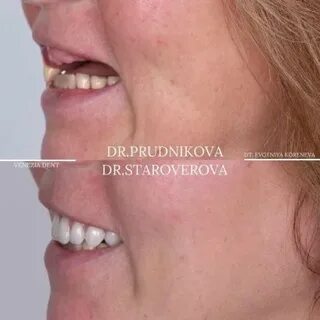 Венеция дент