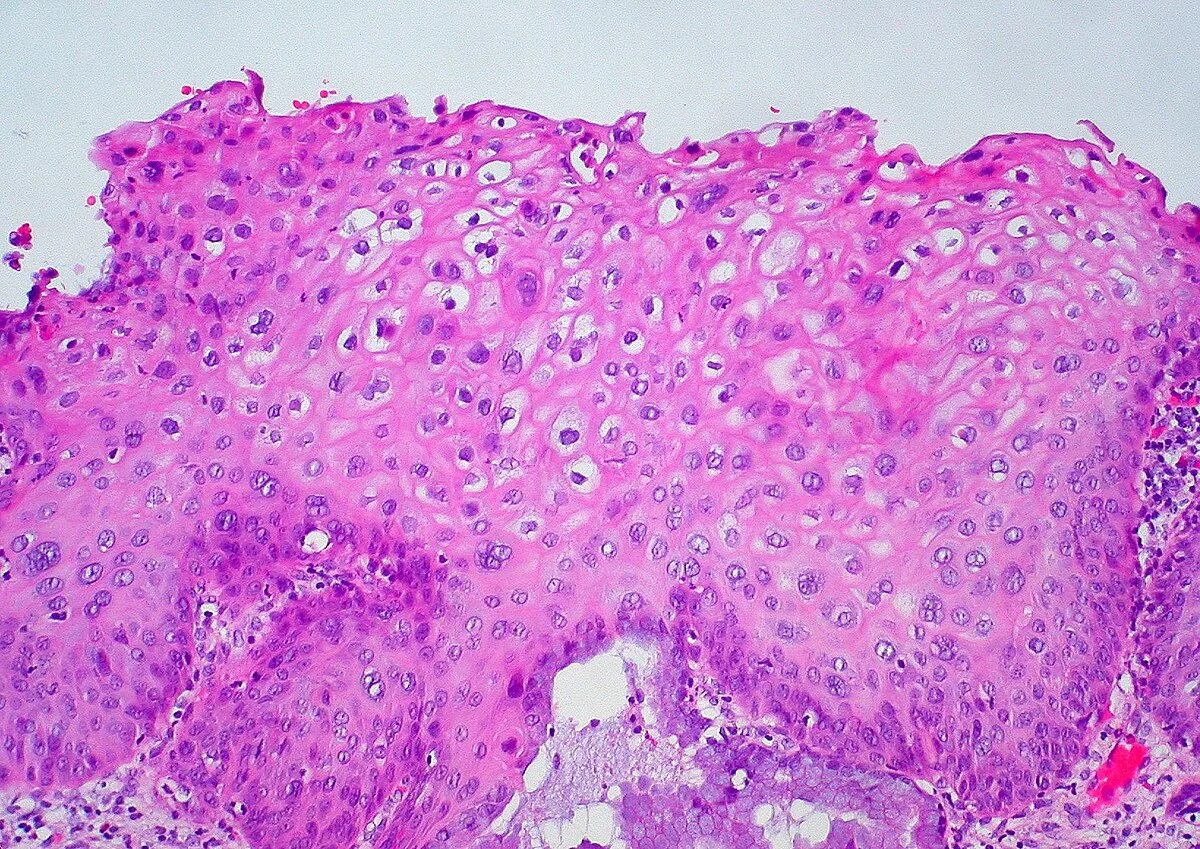 Койлоцитоз шейки матки гистология. Плоский эпителий шейки матки гистология. Цин шейки матки гистология. Койлоцитоз гистология.