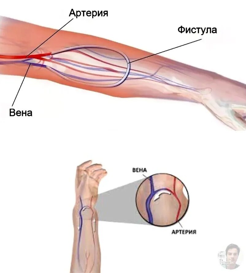 Фистула. Артериовенозная фистула.