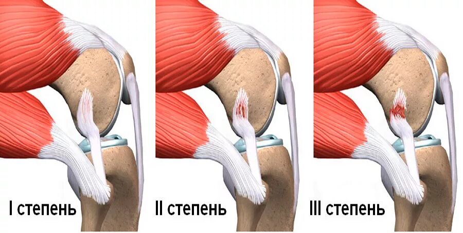 1 пр клонить колени. Внутрикапсулярные связки коленного сустава. Микроразрыв связок коленного сустава. Тендинит сухожилия подколенной мышцы. Ушиб подколенного сухожилия.