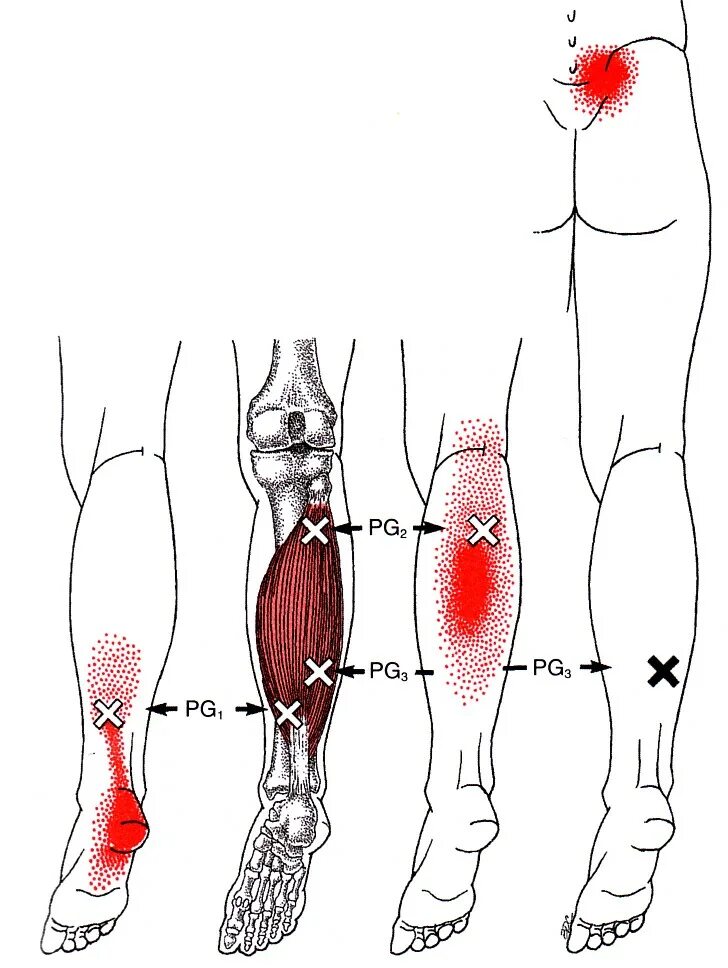 Боль в икрах причины у мужчин. Триггерные точки икроножной мышцы. Триггерные точки мышц голени. Триггерные точки камбаловидной мышцы. Триггерные точки большеберцовой мышцы.