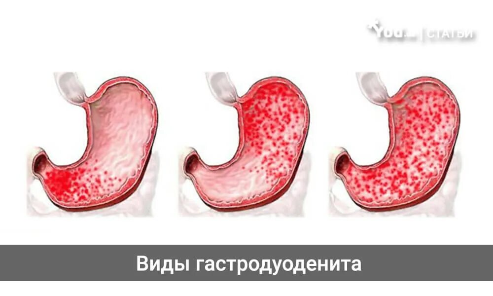 Может ли гастродуоденит. Хронический антральный гастрит симптомы. Хронический атрофический гастродуоденит. Локализация хронического гастрита.