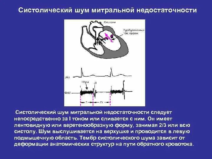 Шум при митральной недостаточности