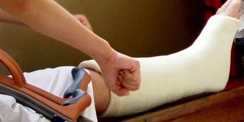 Накладывают ли гипс при растяжении связок