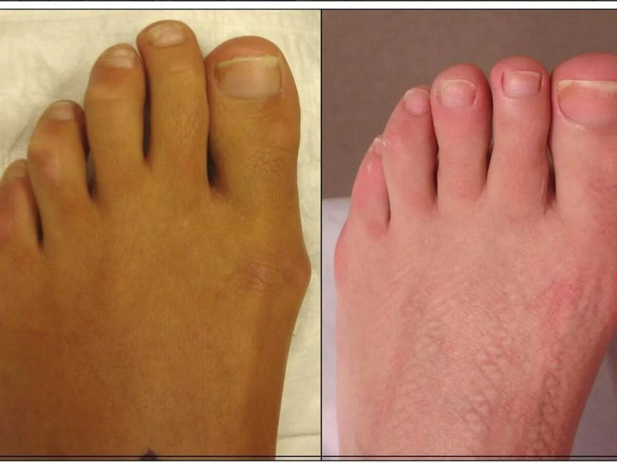 Гимнастика для рук и пальцев при ревматоидном артрите. Уменьшение пальцев. Наращивание на большие пальцы. Операция по уменьшению пальца на ноге. Маникюр на широкие больше пальцы рук.