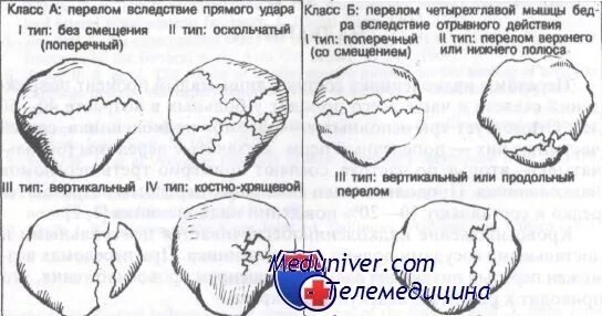 Перелом надколенника код по мкб 10. Переломы надколенника классификация. перелом верхнего полюса надколенника. перелом надколенника классификация ао. типы переломов надколенника.
