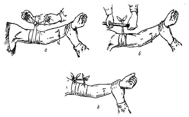 Артериальное кровотечение схема. Наложение повязки при артериальном кровотечении. Схема остановки кровотечения. Схема наложение жгута при кровотечении.