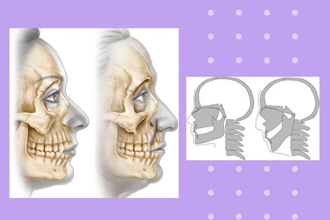 Основным признаком возрастных изменений костей. Резорбция костной ткани черепа. Костная резорбция челюсти. Резорбция костей лицевого черепа. Возрастные изменения костей лицевого скелета.
