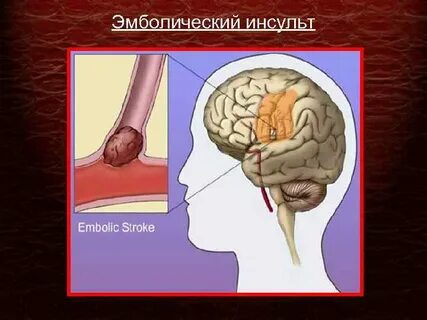 Ишемический кардиоэмболический инсульт